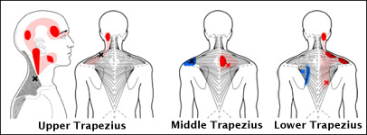 Muscle-Trigger-Points-Neck-Upper-back